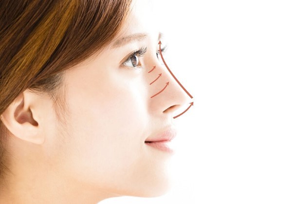 Những phương pháp phẫu thuật nâng mũi phổ biến